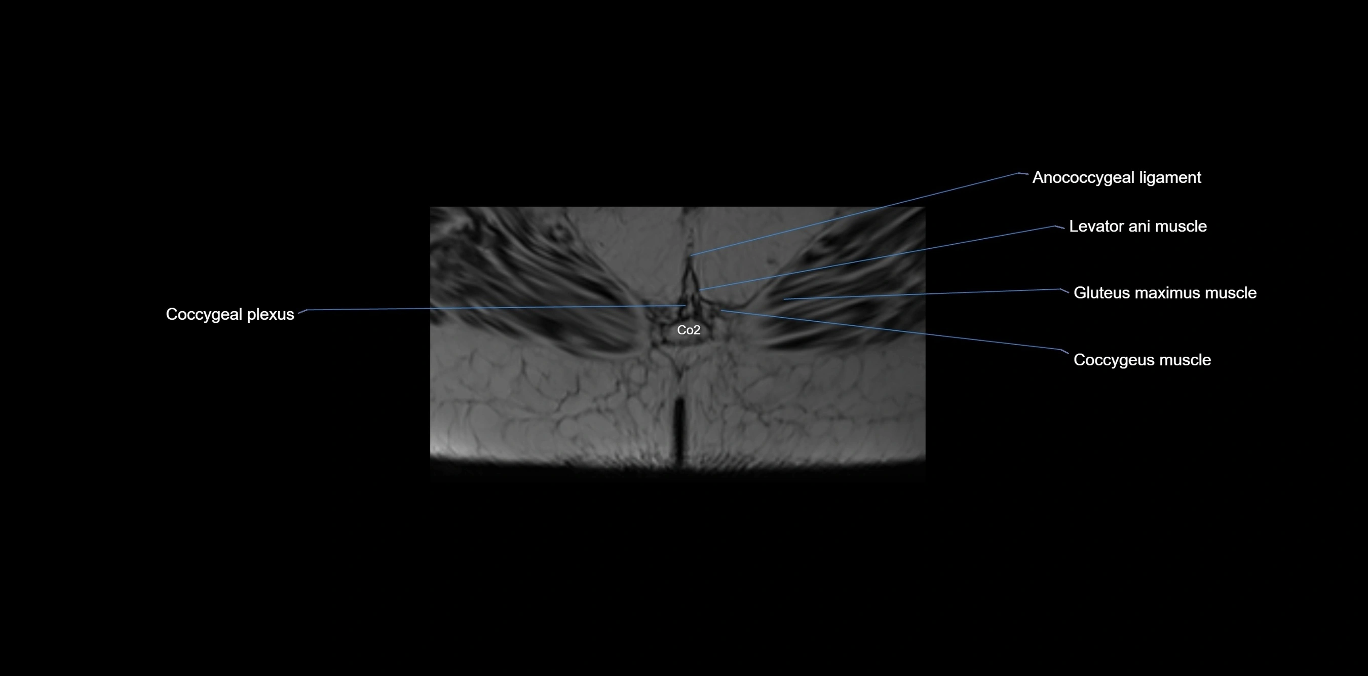 MRI sacrum, coccyx and sacroiliac joint axial cross sectional anatomy 3T  radiology  image-img-00001-00077.webp